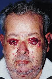 Patient with Kaposi's sarcoma of the head and neck.