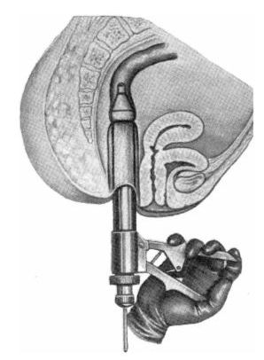 Proctological instrument 