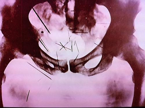 X-ray showing pins in Albert Fish's groin 