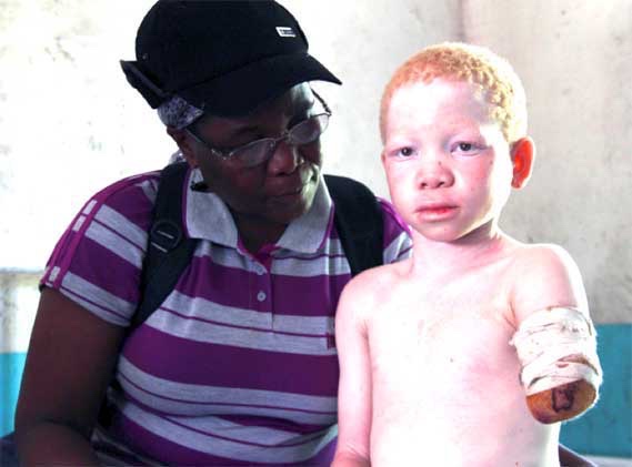 African albino boy with arm hacked off