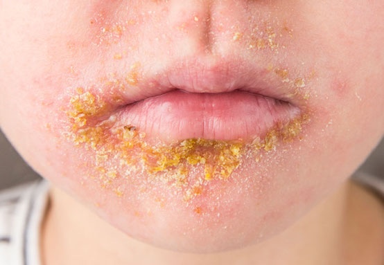 Face rash on child 